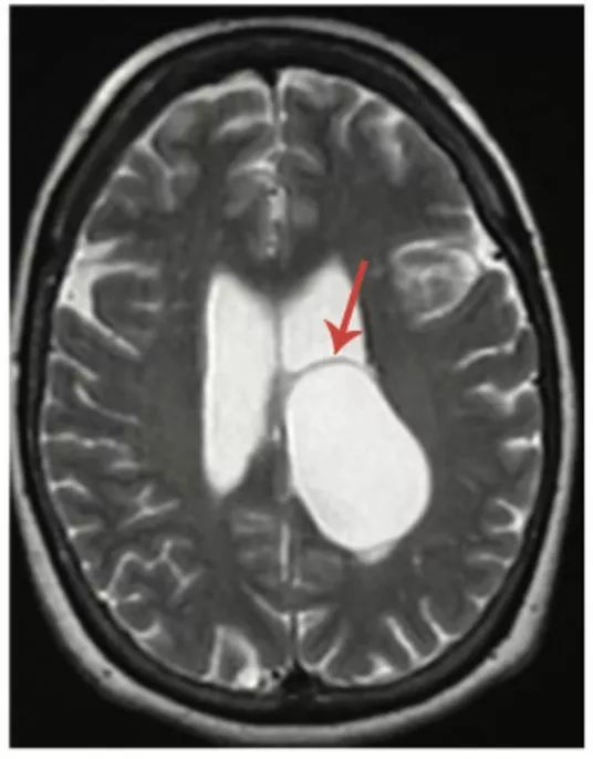 多图多表：带你识别颅内囊肿的影像学表现丨实战读片