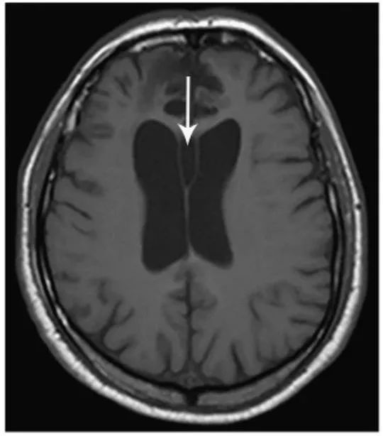 多图多表：带你识别颅内囊肿的影像学表现丨实战读片