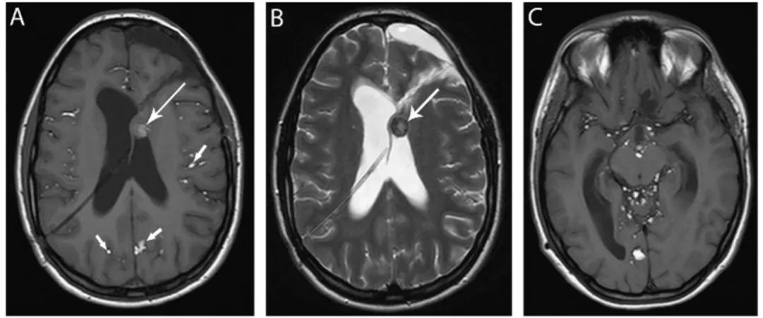 多图多表：带你识别颅内囊肿的影像学表现丨实战读片