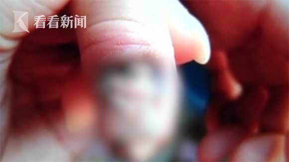 11岁孩子指甲出现溃烂,11岁孩子指甲根部出现溃烂