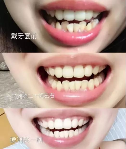 别人矫牙1万起，广州只要3960元！仅限2天