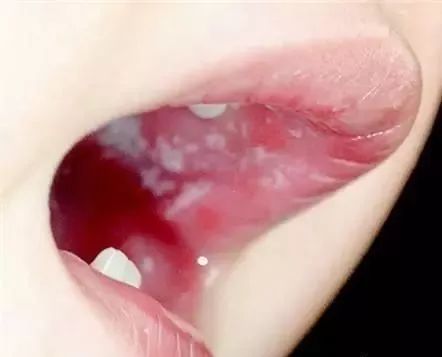 婴幼儿育儿问题有哪些及如何解决,健康育儿鹅口疮