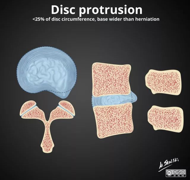 椎间盘膨出脱出图解,椎间盘膨出脱出和突出哪个更严重