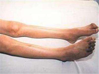 引起肌肉萎缩的原因,如何正确快速的诊断肌肉萎缩疾病