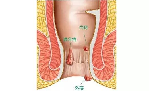 滨州肛肠医院治痔疮,滨州市哪家医院治疗痔疮比较权威