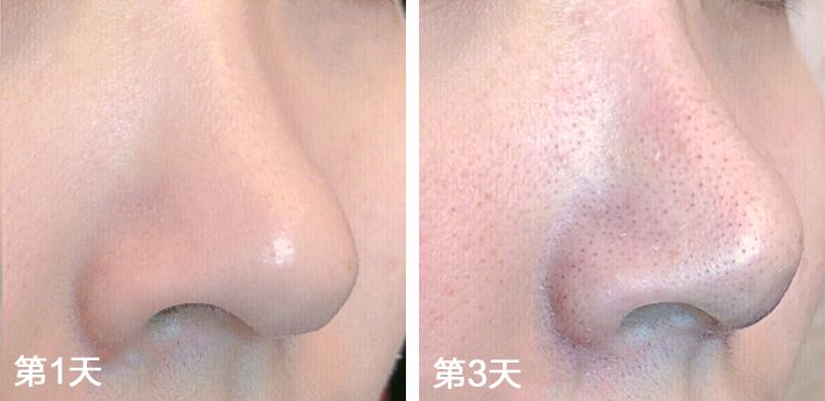 黑头用黑头膏为什么去不掉黑头,清洁黑头推荐用黑头仪还是黑头铲