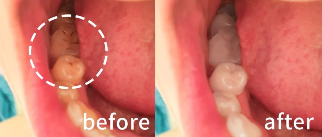 秒除口臭,一秒解决当天口臭