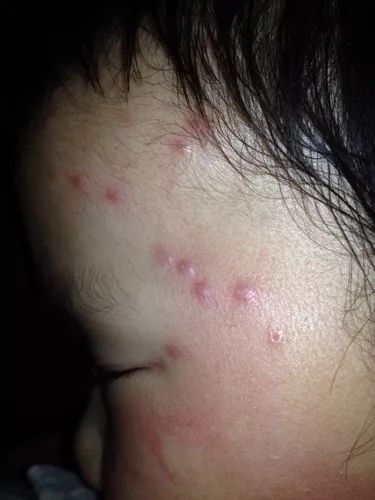 儿童虫咬皮炎科普视频,中医怎么治疗儿童虫咬皮炎