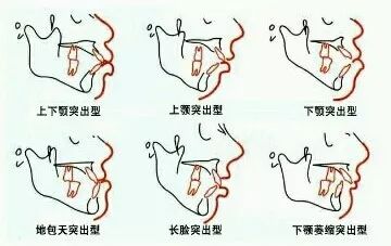 大龄整牙,错过生长发育期怎么办
