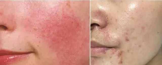 脸上搓下来很多泥,脸上搓出黑头