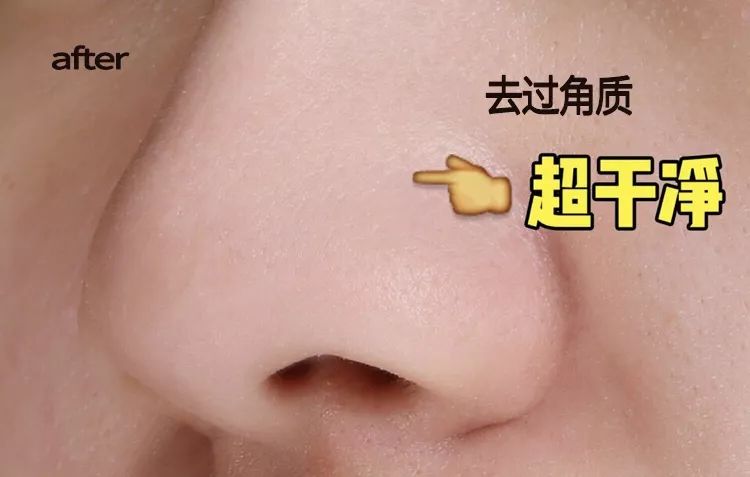 脸上搓下来很多泥,脸上搓出黑头