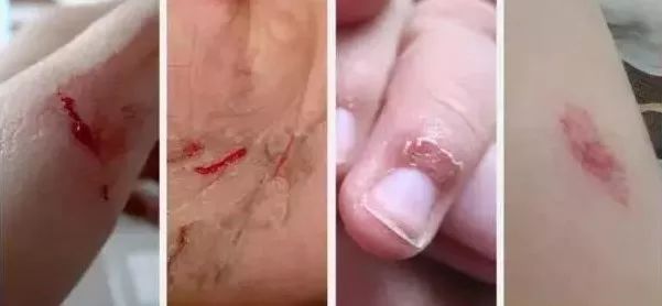 比创可贴好用,最好用的液体创可贴