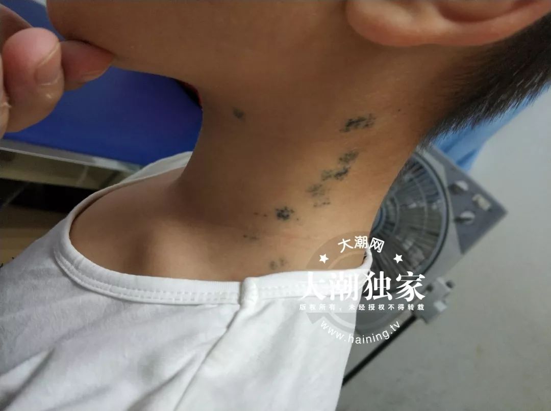 瑙︾洰鎯婂績灏忓,10宀佺敺瀛╄剸瀛愪笂鍏ㄦ槸閽堢溂鏂伴椈