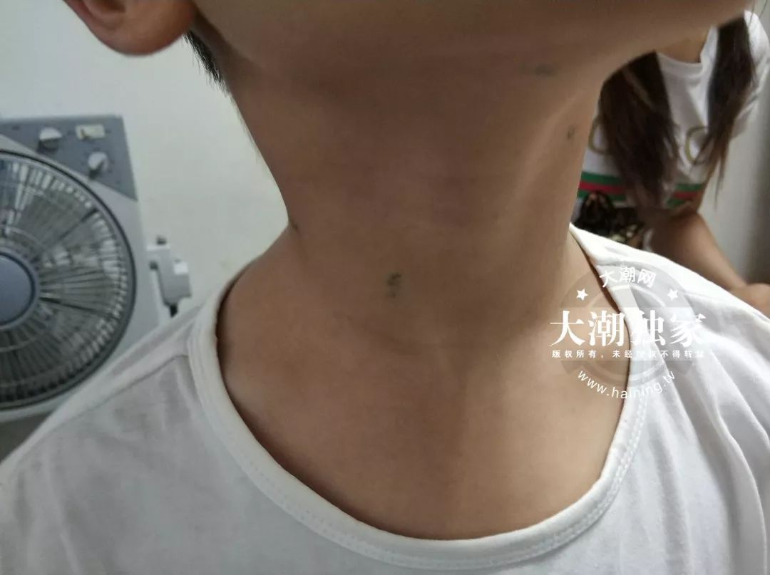 瑙︾洰鎯婂績灏忓,10宀佺敺瀛╄剸瀛愪笂鍏ㄦ槸閽堢溂鏂伴椈