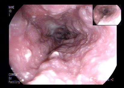 土三七中毒治好后肝能恢复正常吗,土三七中毒所致的肝损害的治疗