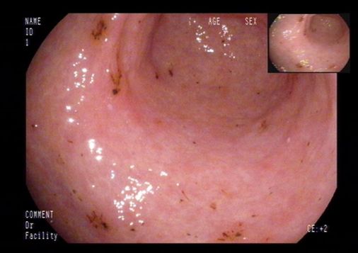 土三七中毒治好后肝能恢复正常吗,土三七中毒所致的肝损害的治疗