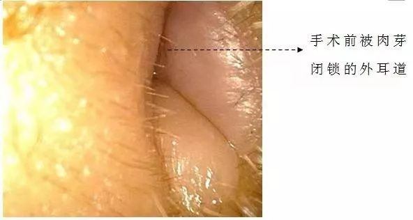 姑娘耳屎太多被同事吐槽,耳屎太多检测报告
