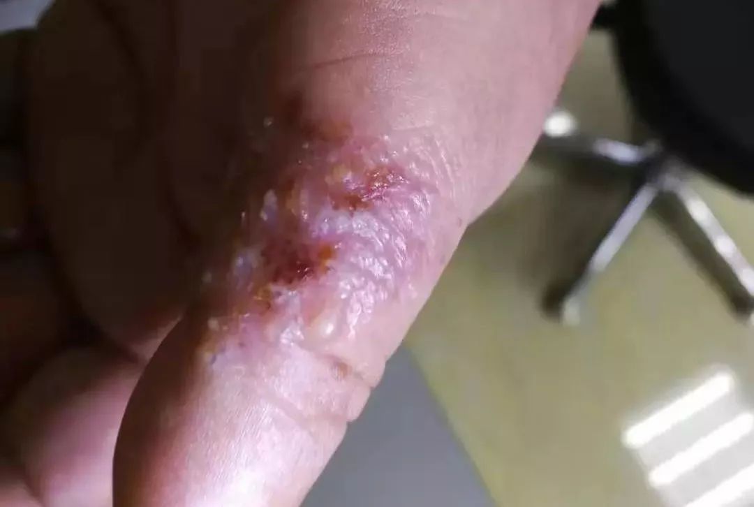 这个季节手上会起小泡怎么能根治,气温回升手上就开始长小水泡