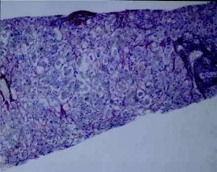 一文汇总：妊娠期急性脂肪肝的危险因素、发病机制和诊治要点