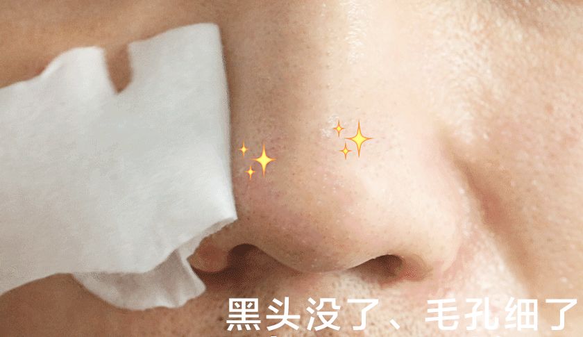 黑头用黑头膏为什么去不掉黑头,清洁黑头推荐用黑头仪还是黑头铲