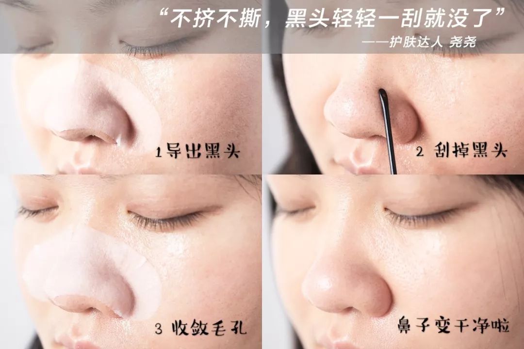 黑头用黑头膏为什么去不掉黑头,清洁黑头推荐用黑头仪还是黑头铲