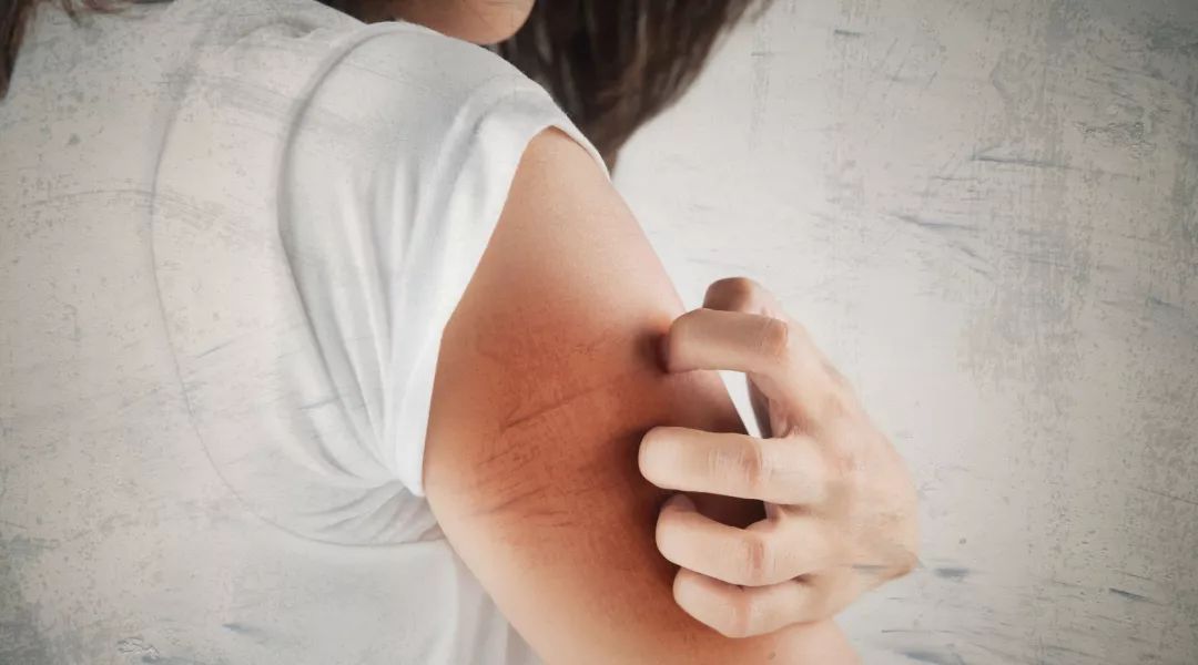 皮肤干燥起皮的救星,皮肤干燥起皮怎么办用什么护肤品