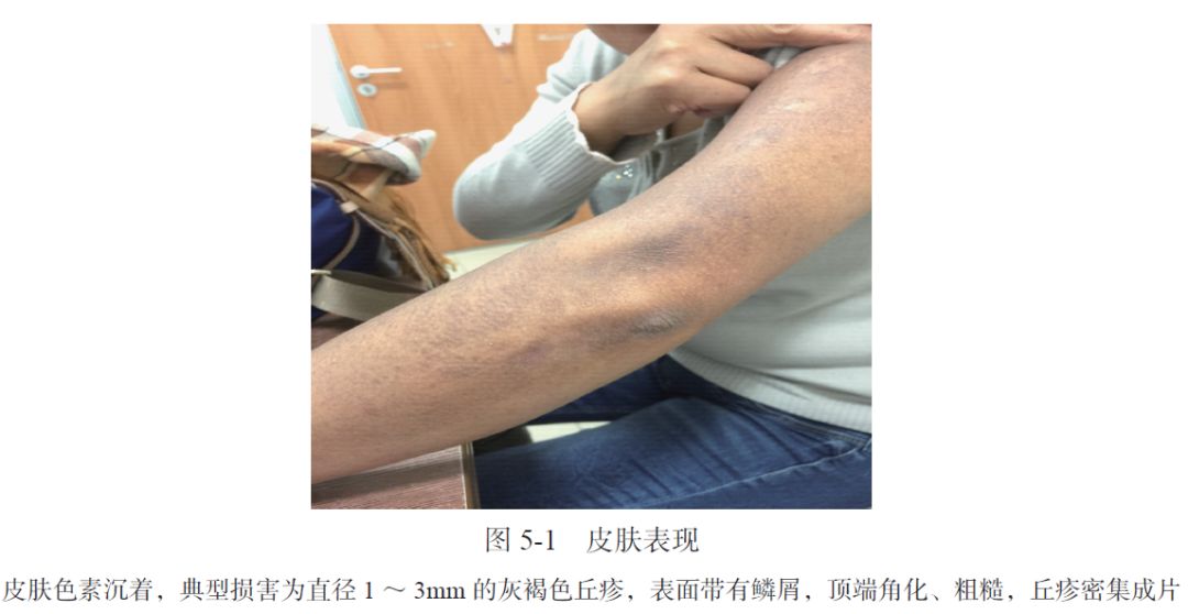 AIH、PBC、干燥综合征三者重叠合并原发性皮肤淀粉样变性1例｜肝脏疾病疑难与经典病例（第四辑）