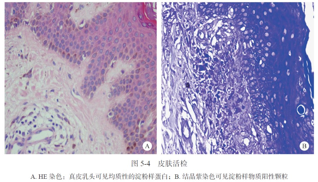 AIH、PBC、干燥综合征三者重叠合并原发性皮肤淀粉样变性1例｜肝脏疾病疑难与经典病例（第四辑）