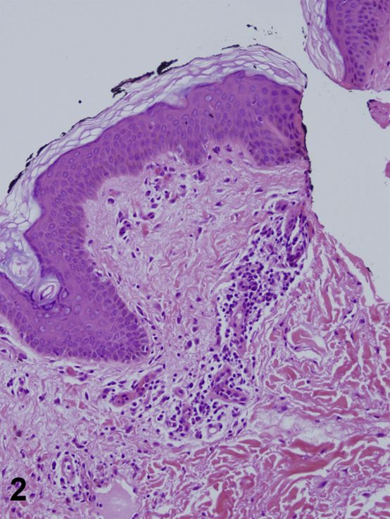 关节性紫癜会出现斑块吗,关节性紫癜有头疼症状吗