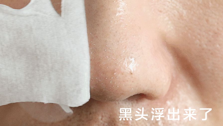 黑头用黑头膏为什么去不掉黑头,清洁黑头推荐用黑头仪还是黑头铲