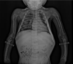 孩子鸡胸补什么钙好呢,小孩鸡胸怎么补钙