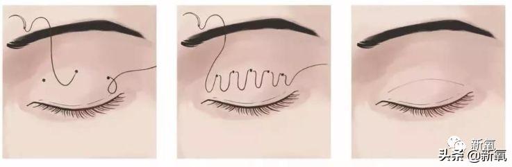 成都医美月▏为朋友埋线却被感染，体内40多根线，30多根都找不到了