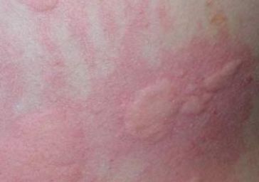 皮肤科荨麻疹的中医疗法,玉颜霜用后为什么起小疹子