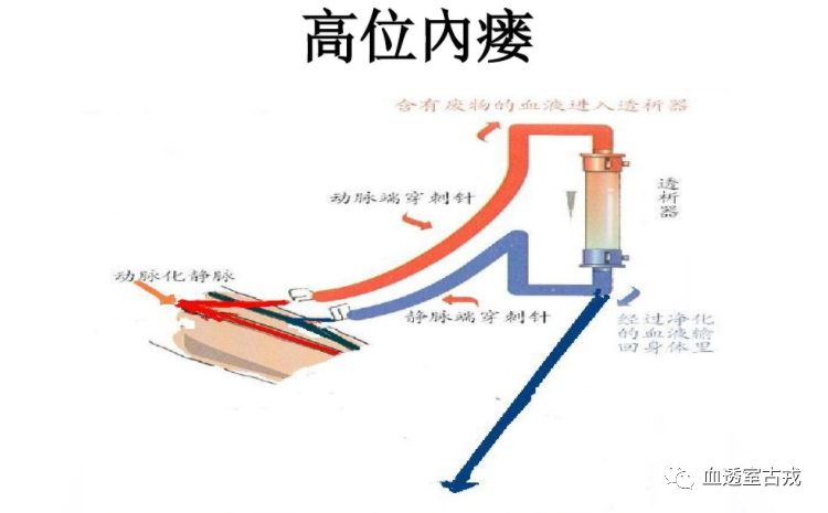 透析病人高位内瘘对心脏有影响吗,透析做高位瘘有啥影响吗