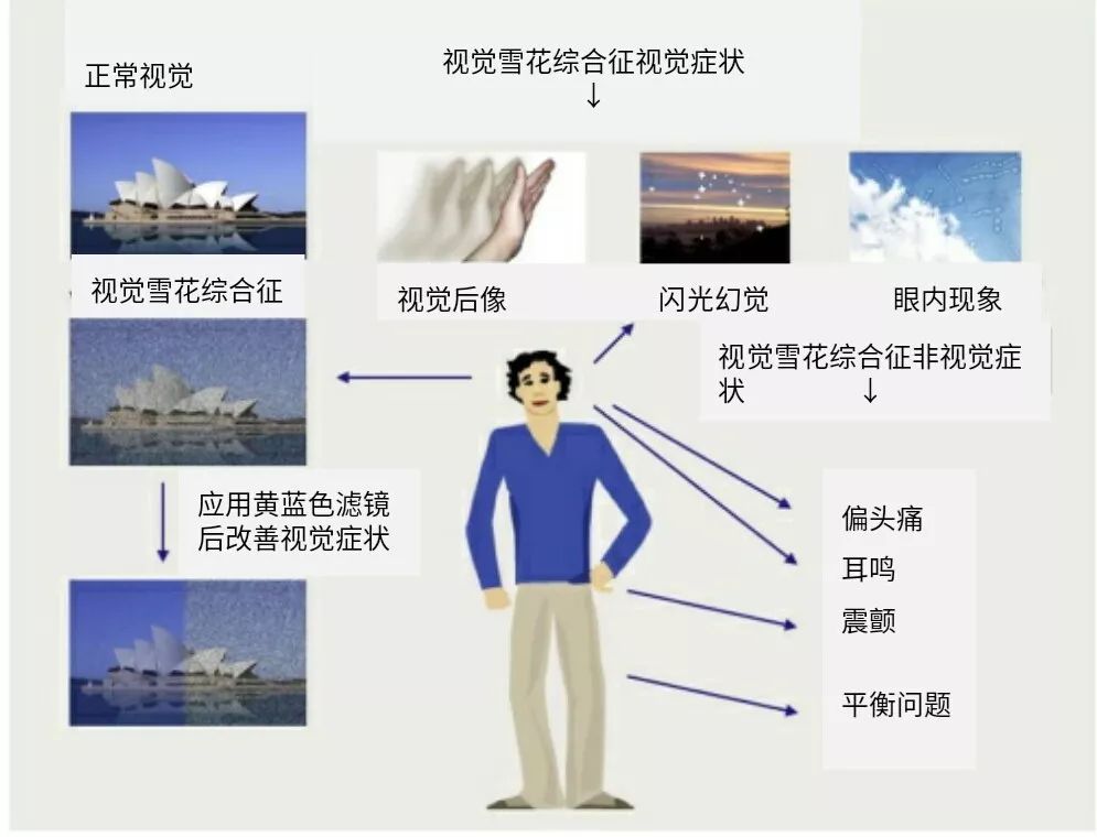 雪花综合征,视觉雪花综合症是先天性的吗