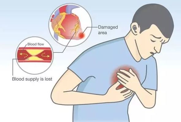 突发心肌梗死错过了最佳十二小时,年轻人心肌梗塞为什么更严重
