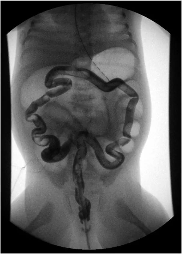 腹胀便秘恶心呕吐是什么病,腹胀腹痛反酸便秘