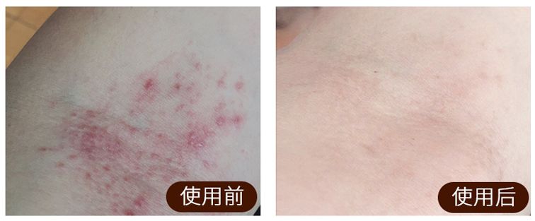 足癣药膏一天涂几次较好,湿疹性皮炎涂了一次药没效果