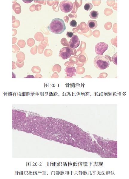 Zieve综合征1例｜肝脏疾病疑难与经典病例（第四辑）