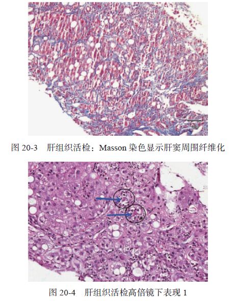 Zieve综合征1例｜肝脏疾病疑难与经典病例（第四辑）