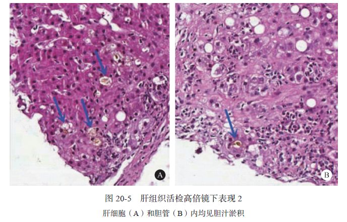 Zieve综合征1例｜肝脏疾病疑难与经典病例（第四辑）