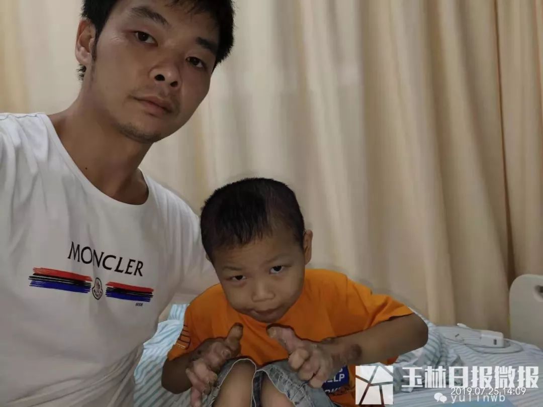 容县太和村小男孩硬皮病治好没有,容县树皮男孩后续