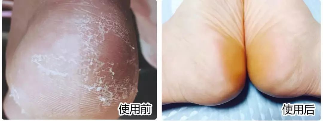 治脚气的抗真菌偏方,角化型脚气干裂最好的药