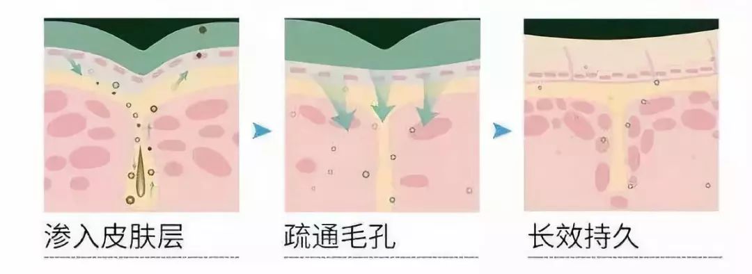 治脚气的抗真菌偏方,角化型脚气干裂最好的药