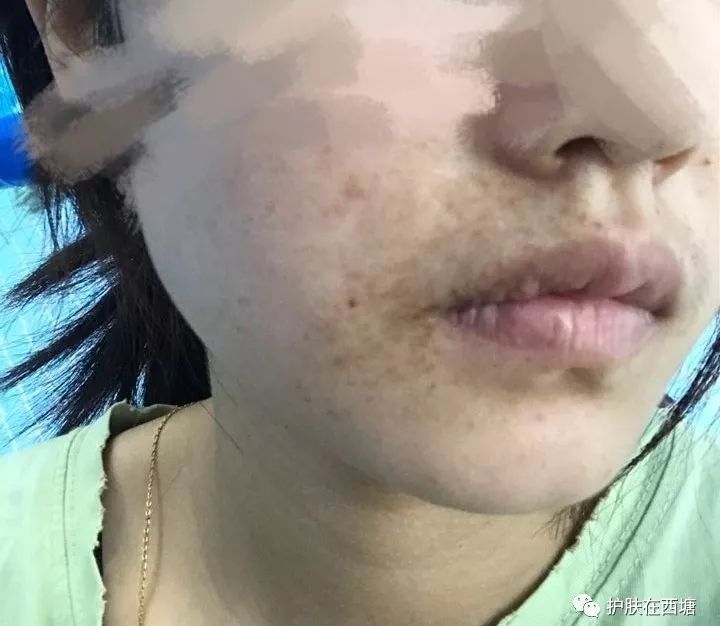 皮秒祛斑的利器,哪里做皮秒激光祛斑