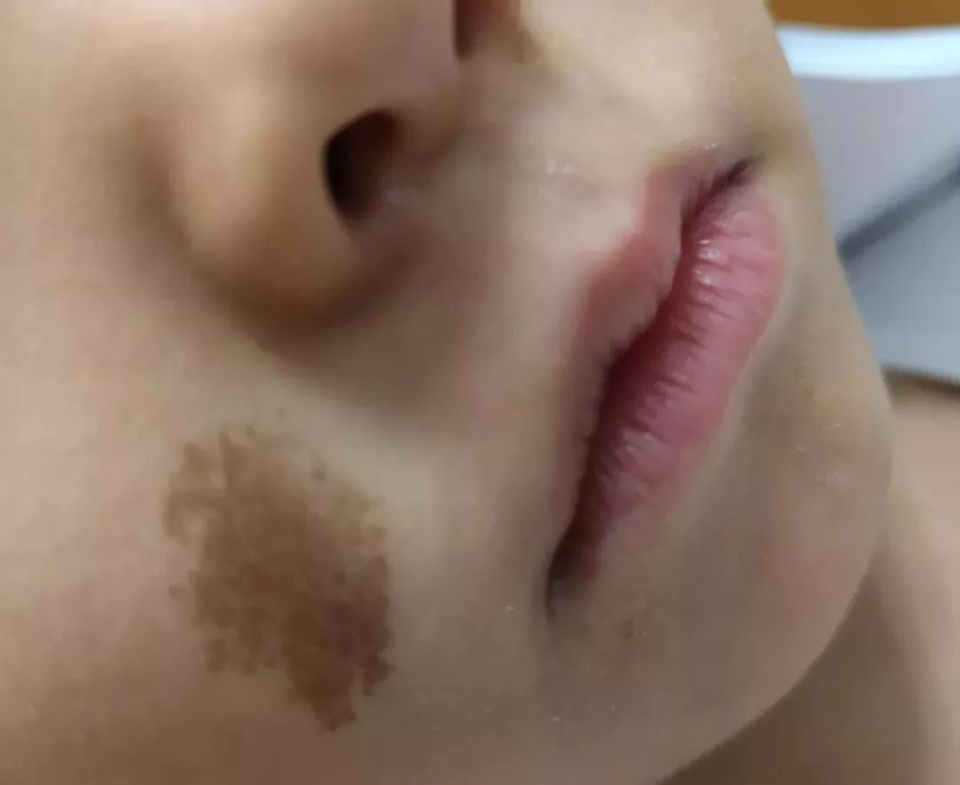 皮秒祛斑的利器,哪里做皮秒激光祛斑