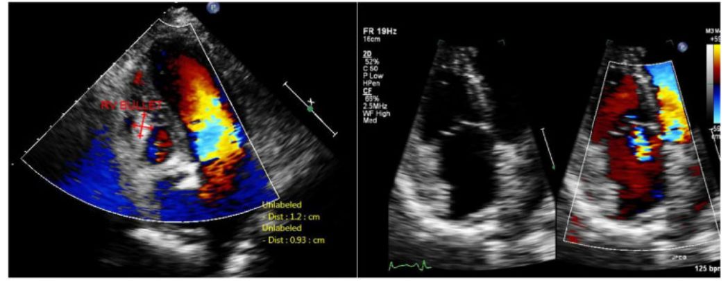 *弹子**栓塞：一波三折的取弹经历｜病例“心”编