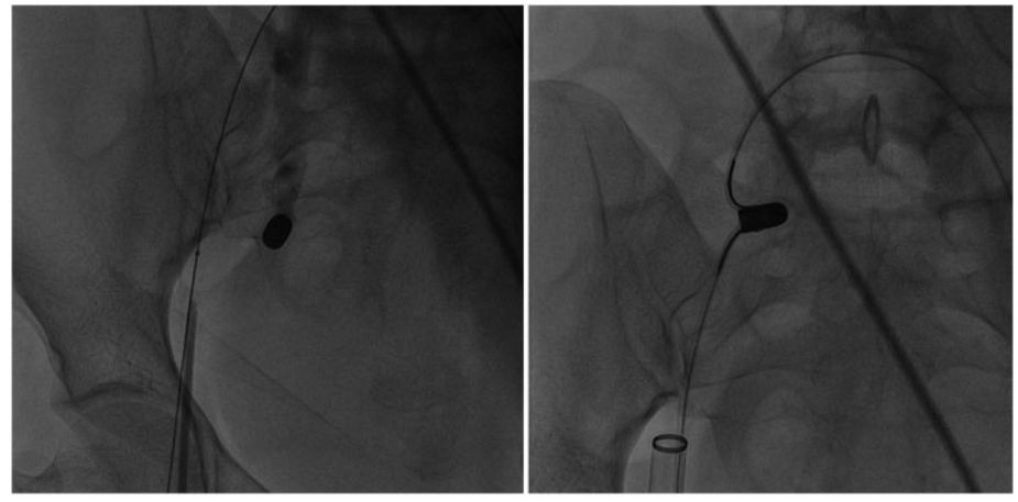 *弹子**栓塞：一波三折的取弹经历｜病例“心”编