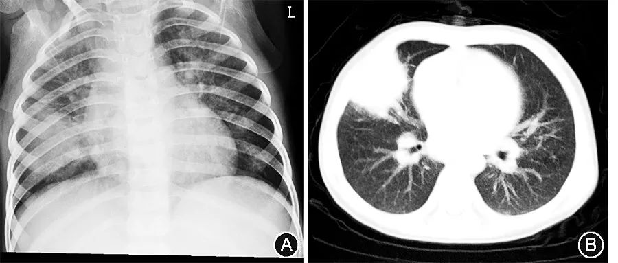 炎症性肠病最主要的症状是,肠肉芽肿性炎是什么病