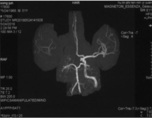 颈内动脉闭塞先进治疗,颈内动脉闭塞开通术病例讨论